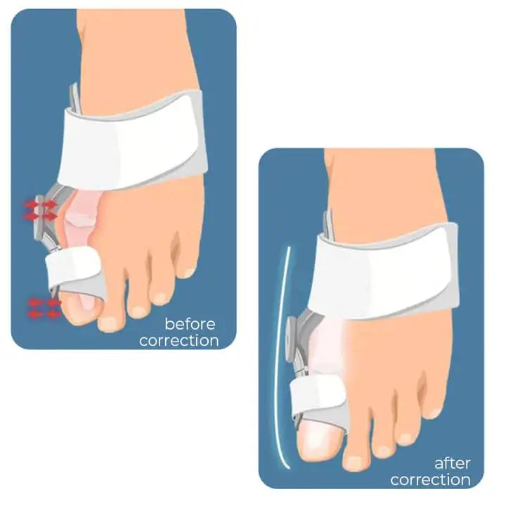 Bunion Corrector JulesRoche Realignment Adjustable Splint